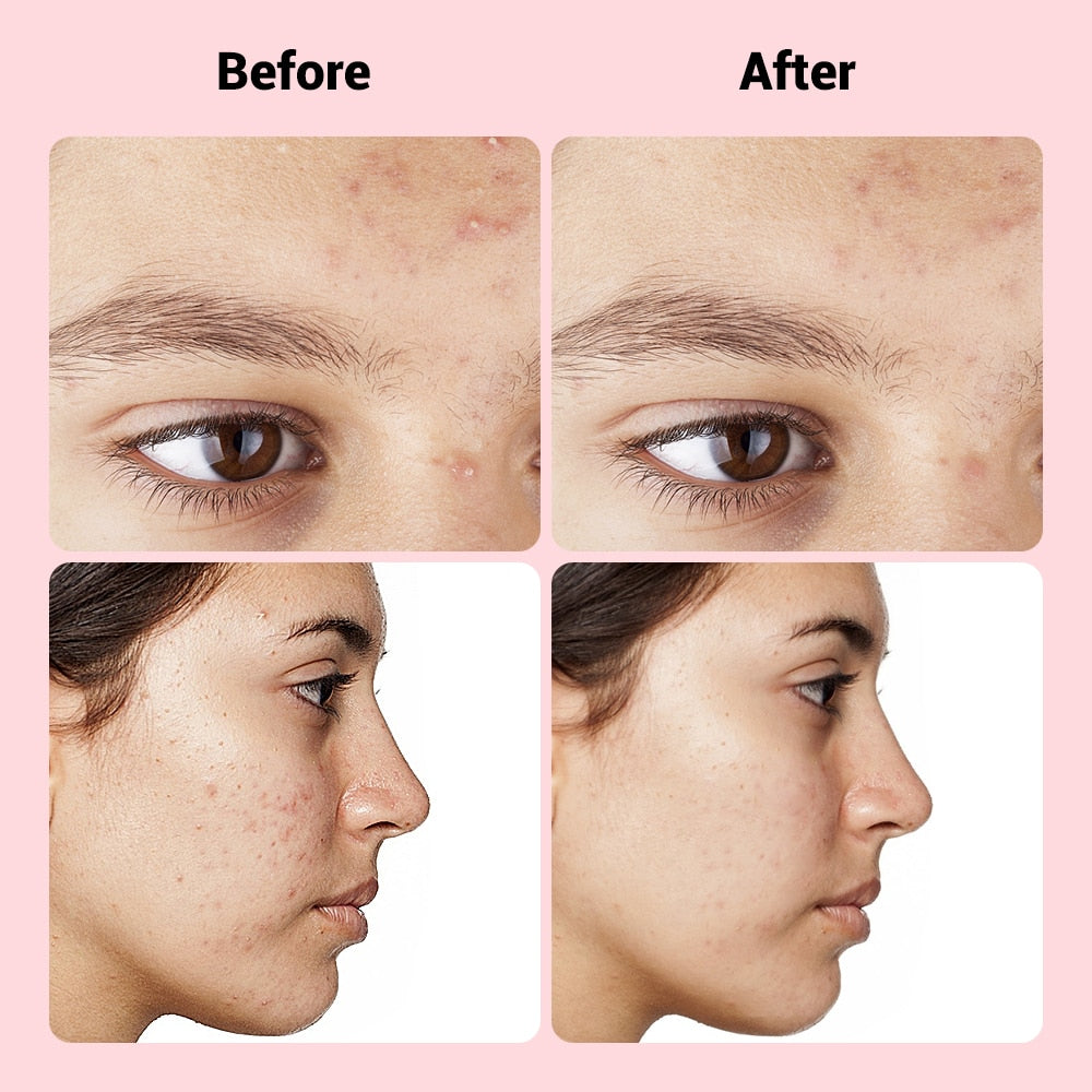 9pcs Translucent Microneedle